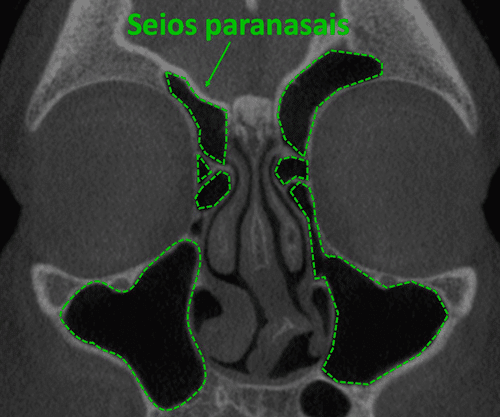 seios paranasais