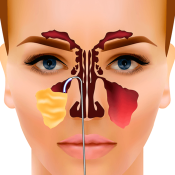 cirurgia de sinusite
