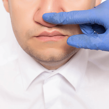 desabamento nasal