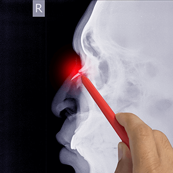 osso nasal fraturado